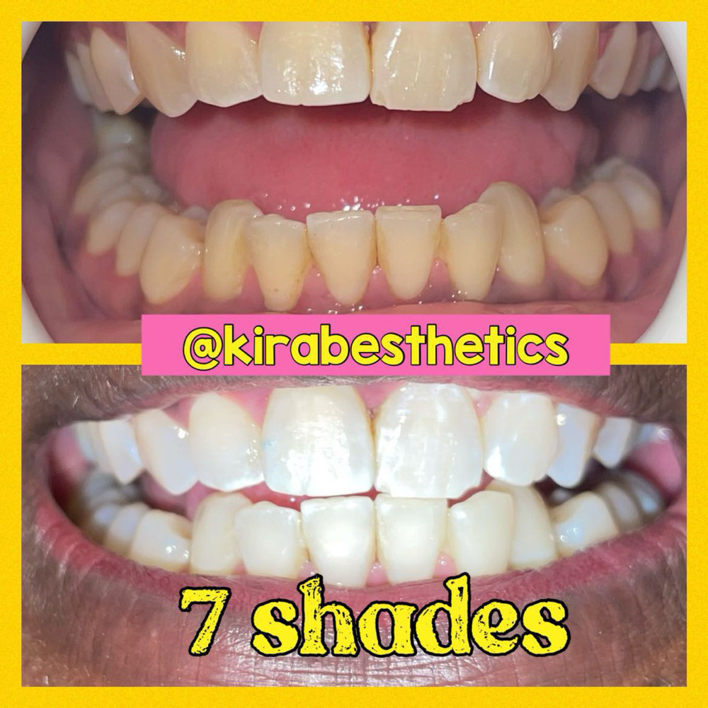 Teeth Whitening 30 mins
