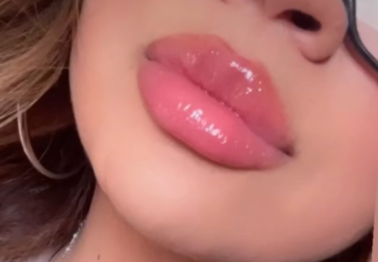 Full Lips With Juvederm Ultra