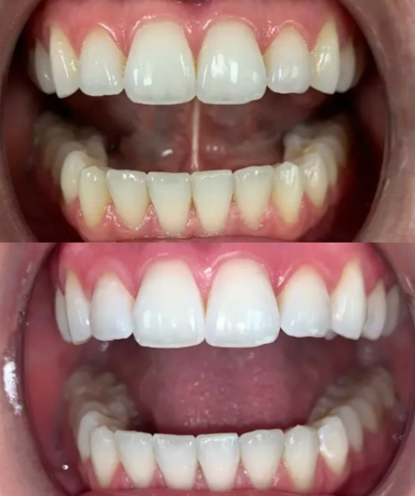Teeth Whitening Package(3 Sessions)