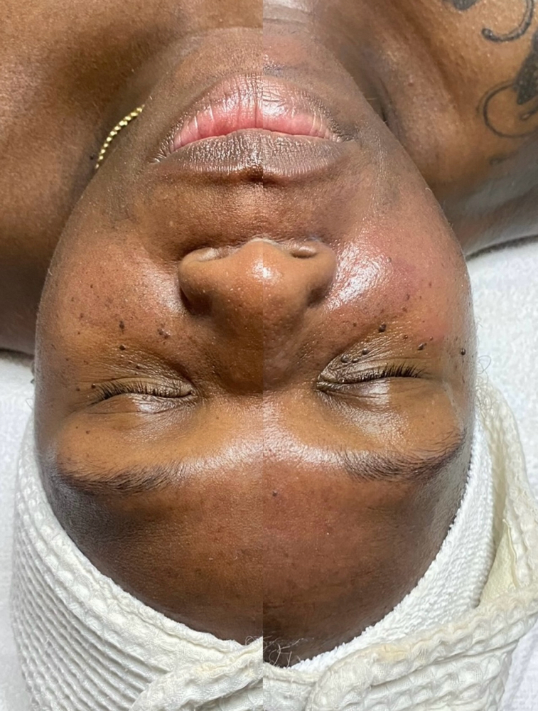 Hydration Facial