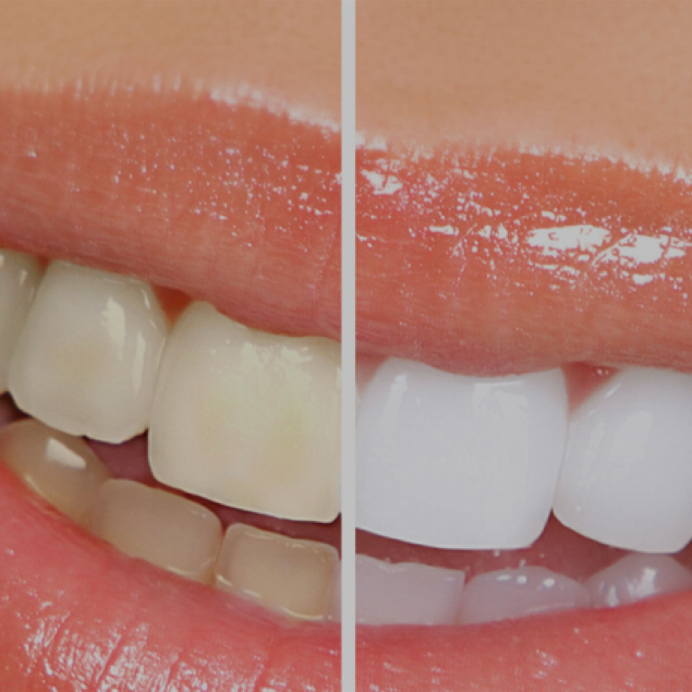 Express Teeth Whitening at SkinWorks & Co. in Gun Barrel City, TX
