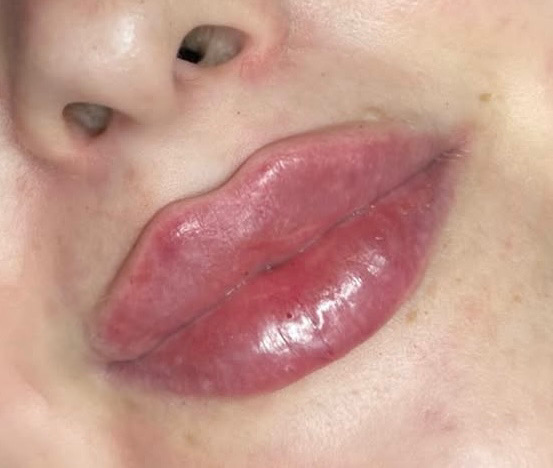 LIPS💋💉