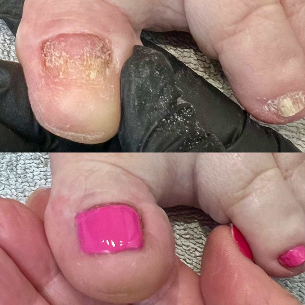 Barefoot Toenail Reconstruction
