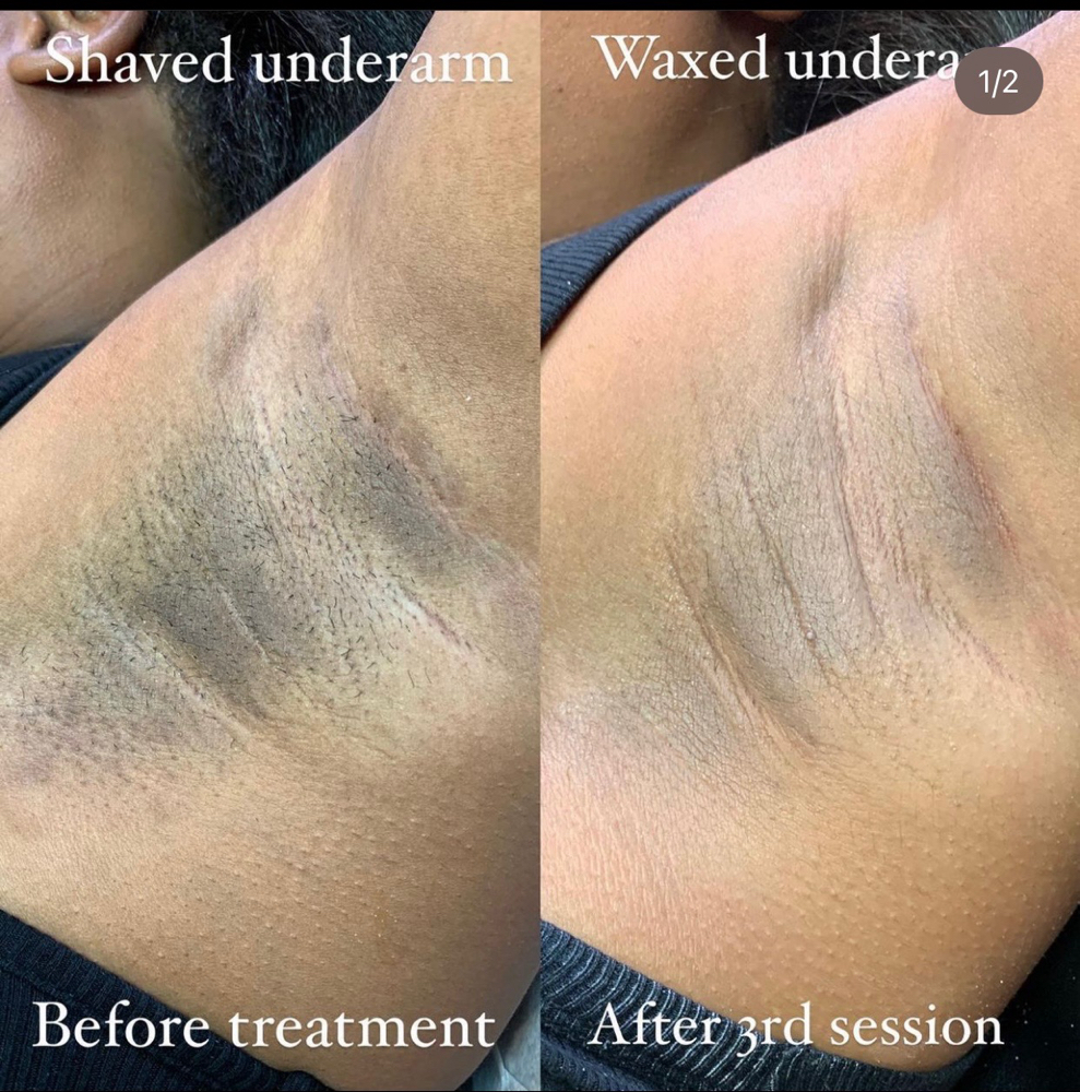 INTIMATE BLEACHING CONSULTATION