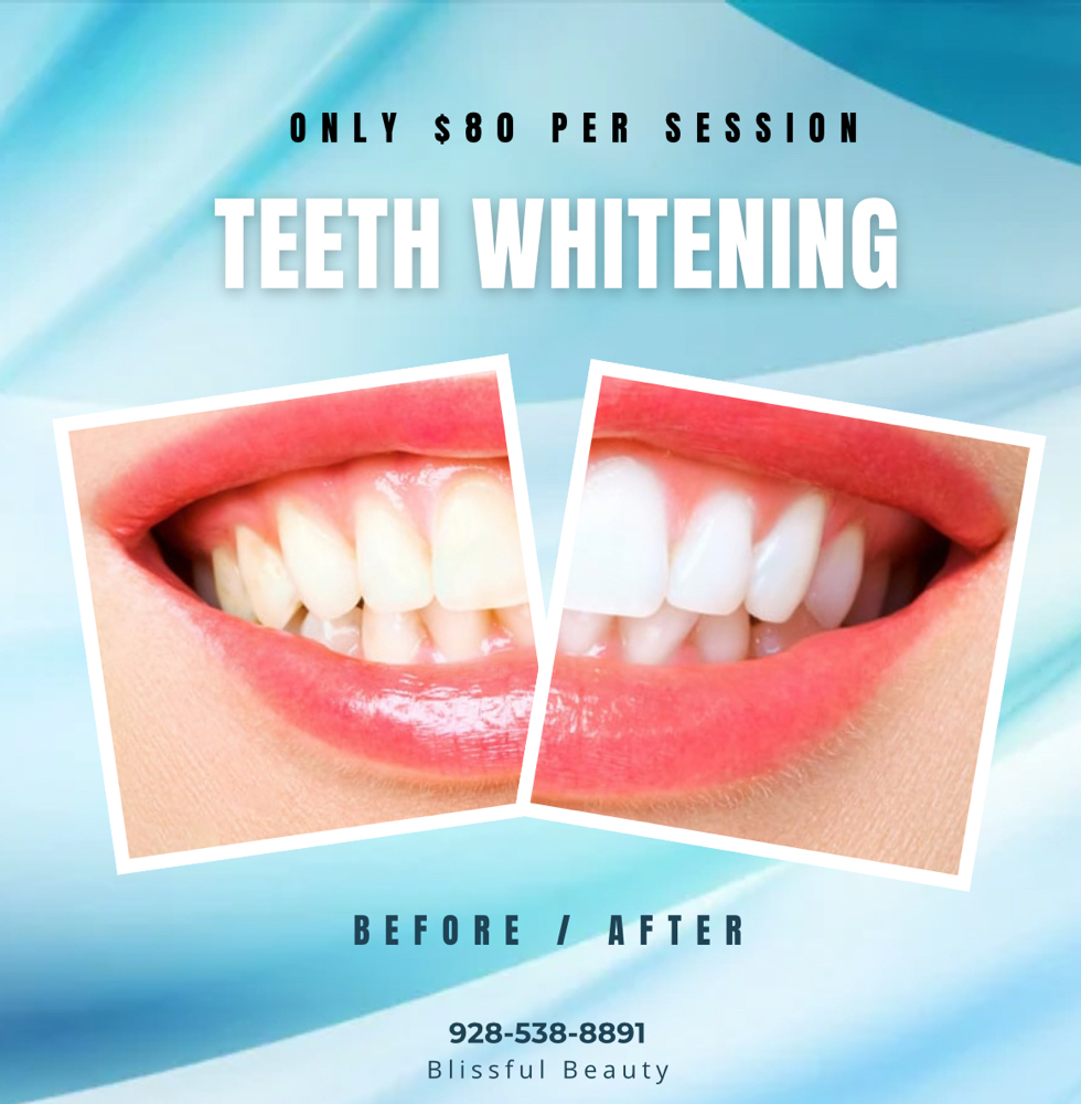 Teeth Whitening Special