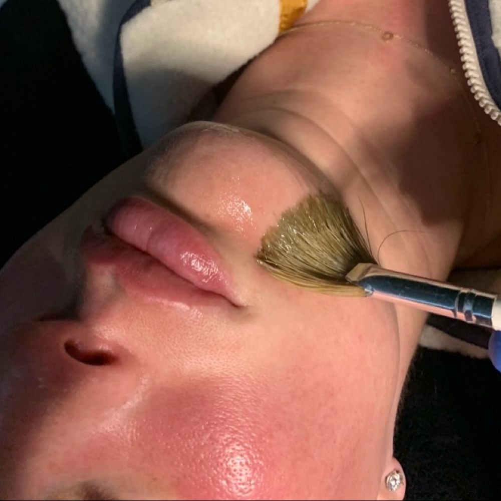 Mokki Custom Clinical Peel at Mökki Aesthetics in Kalispell, MT