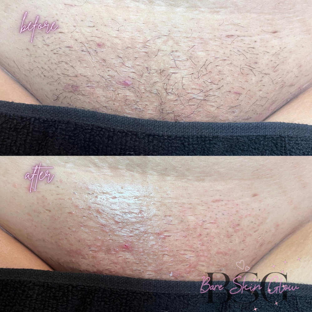 Brazilian Wax (V)