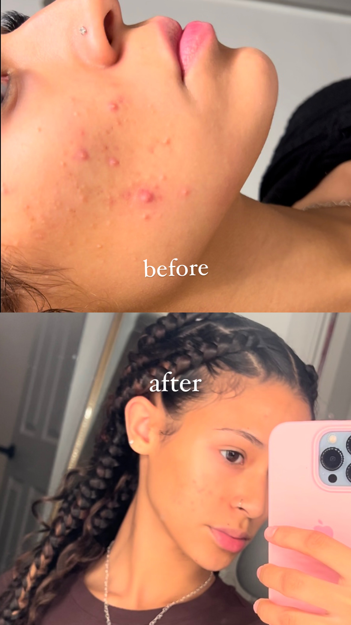Acne Treatment