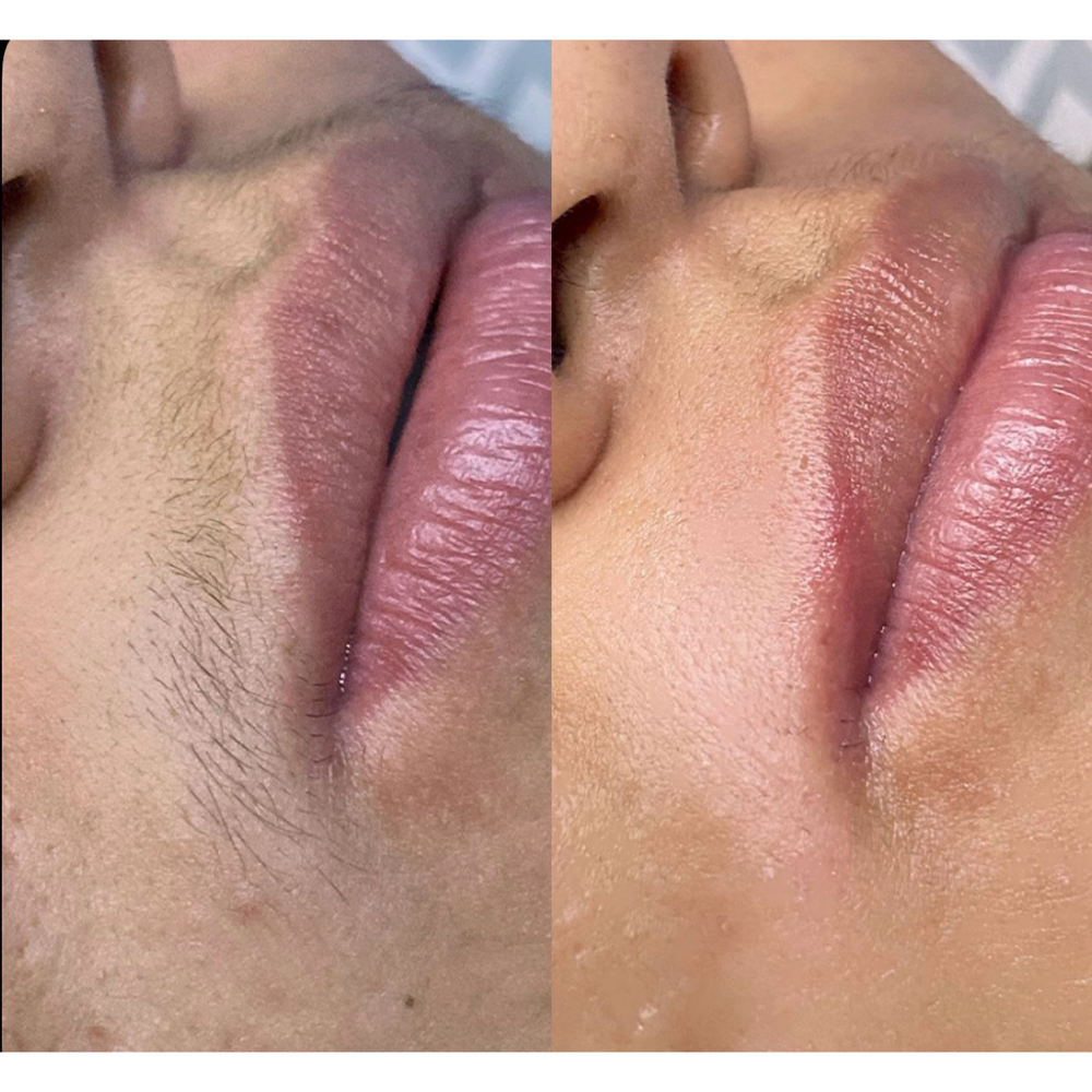 Upper Lip at PureBeauty-Aesthetics in Colorado Springs, CO