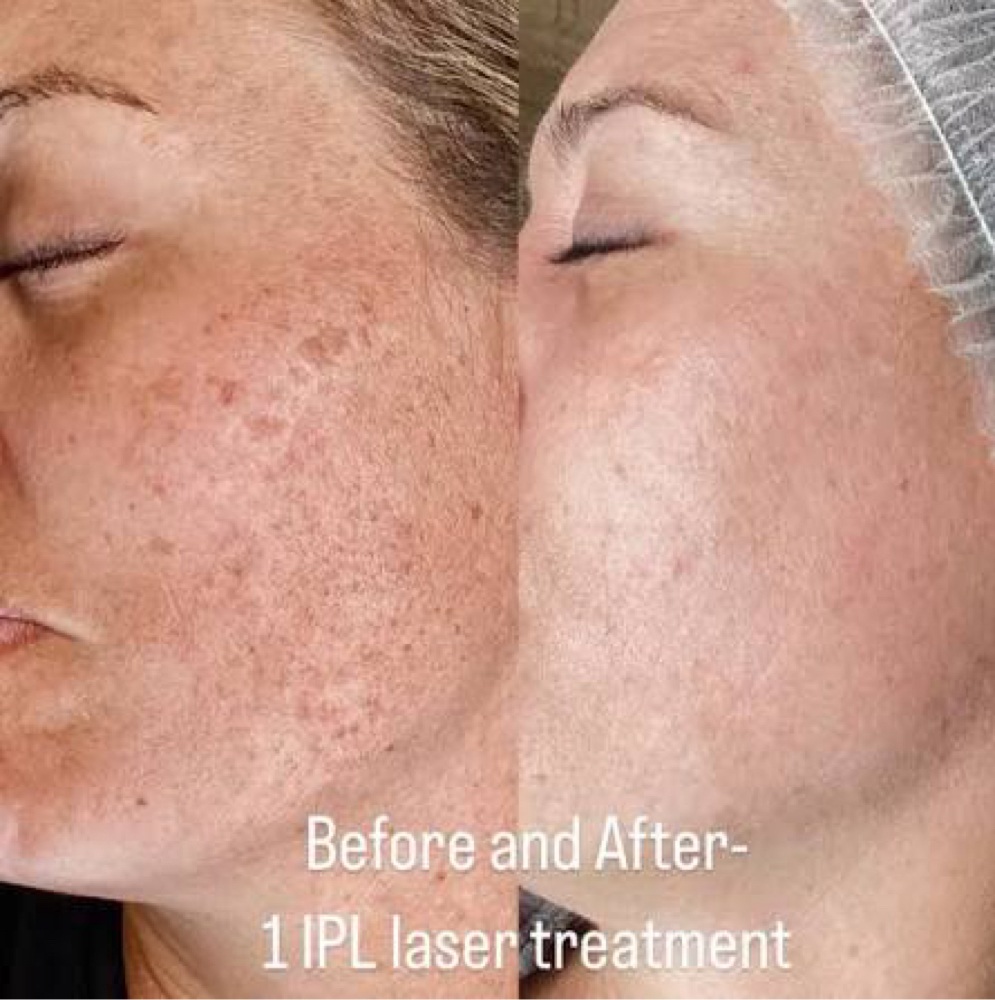 BBL / IPL photofacial Treatments at Luminous Glow Skin & Laser in Buckeye, AZ