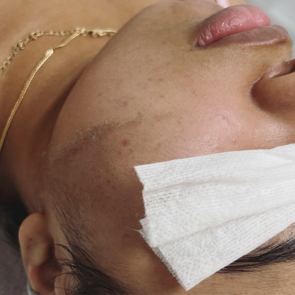 Dermplaning ONLY