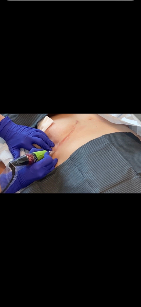 Breast augumentation scars at Permanent Cosmetics By Alicia Polk in Bentonville, AR