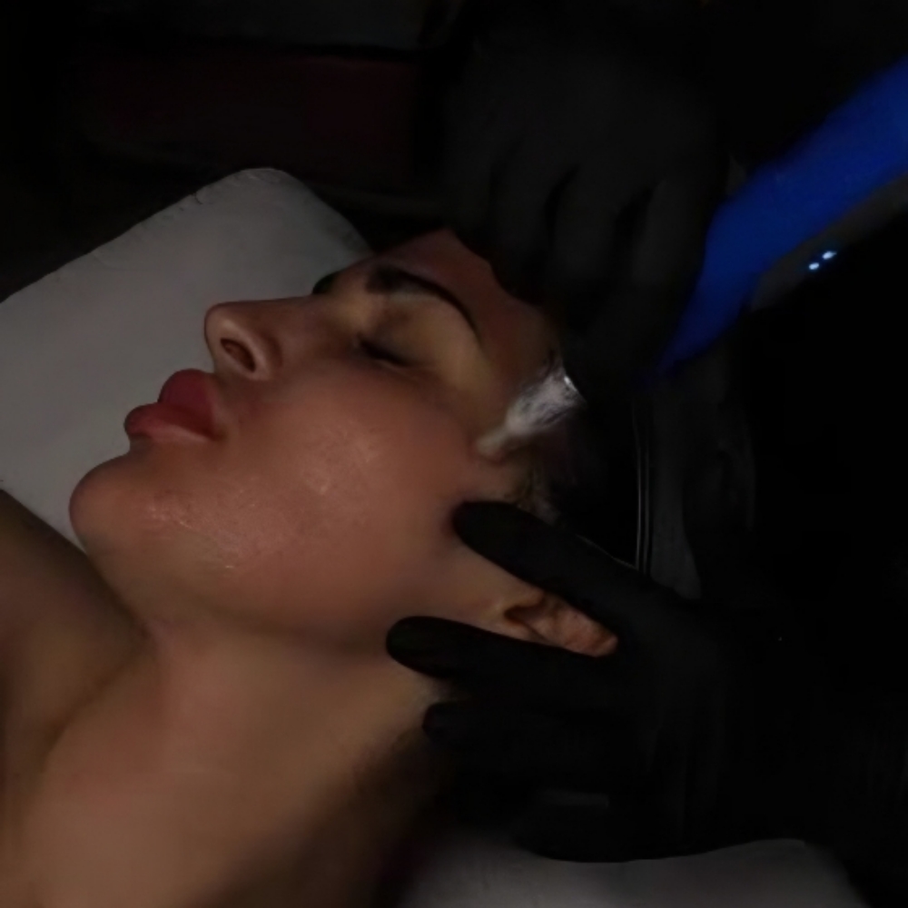 Add On - Nano-needling at LexGlo Esthetics in Idaho Falls, ID