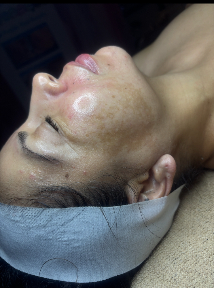 Korean Peel Facial