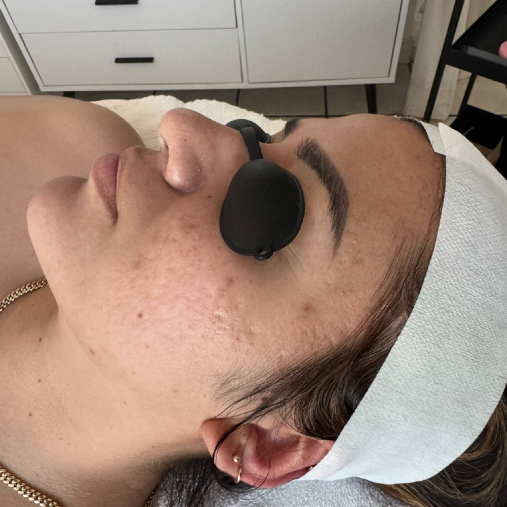 Clarifying Acne Facial at Karla Espinoza in Downey, CA