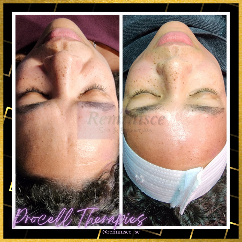 Microneedling (Results Driven)