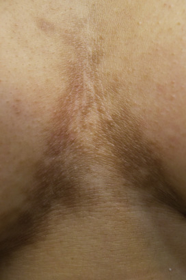 Under Breast Lightening 1 Treatment