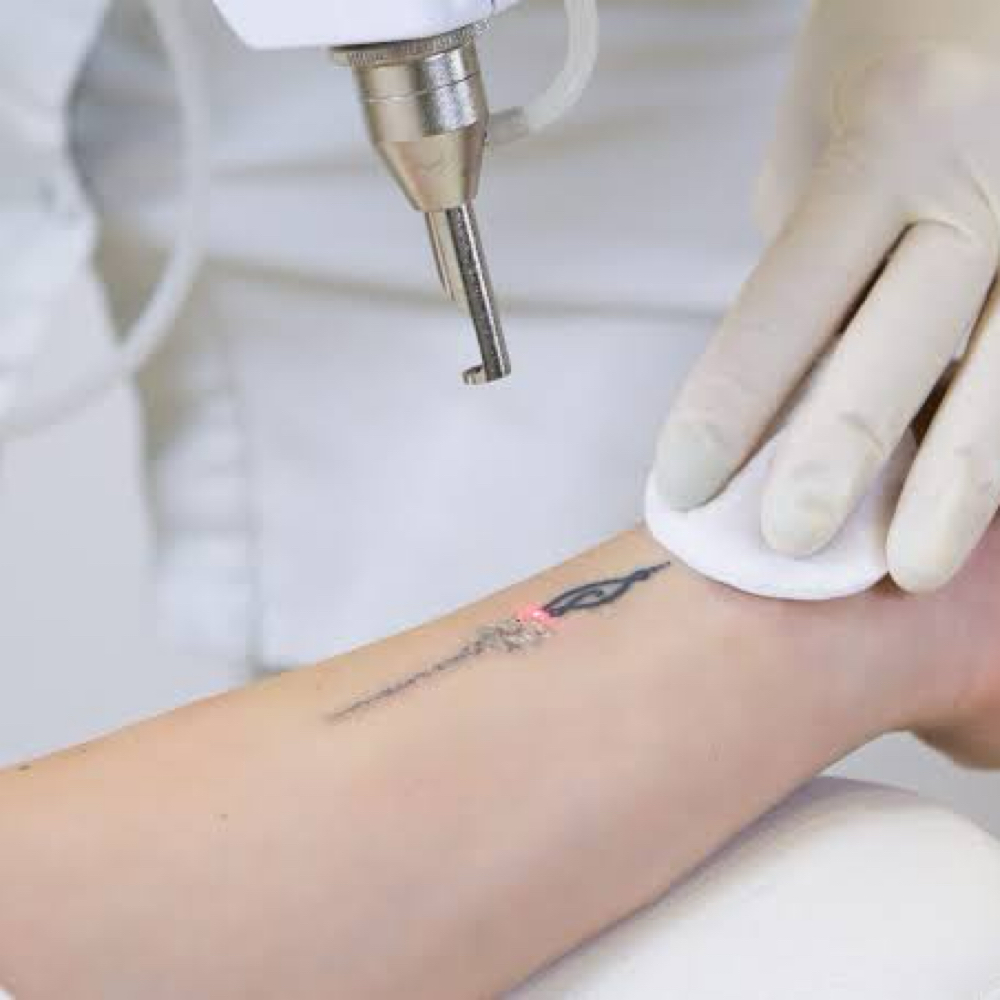 Small Tattoo Removal at Cedar & Sage Aesthetics & Wellness in Hiawassee, GA