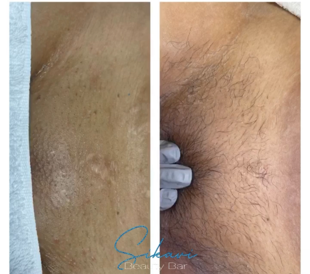 Brazilian Wax