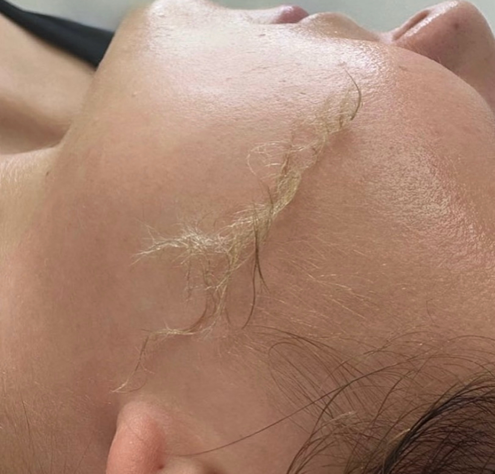 Dermaplaning