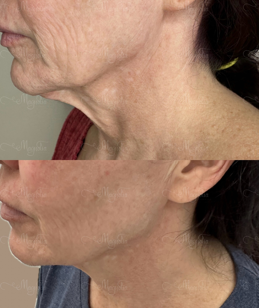 Neck Lift