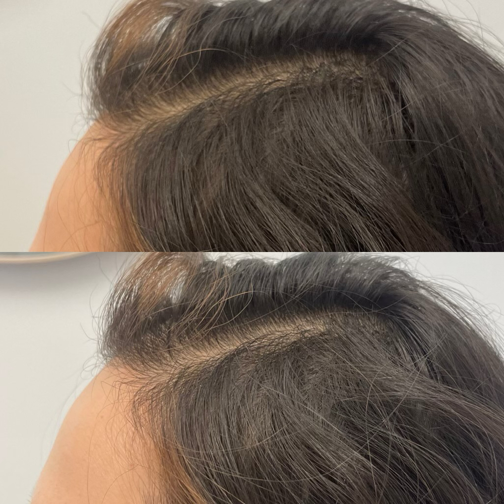 Rf Microneedling-Hair restoration