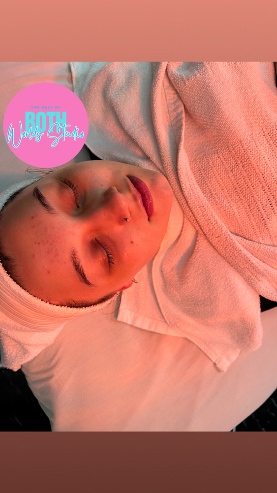 Acne “Be Gone” Facial