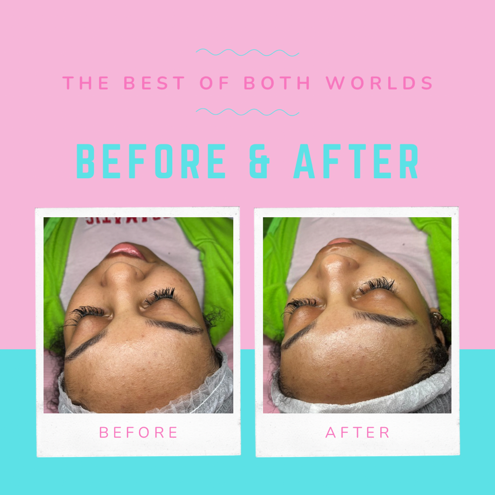 “Be Gone” Acne Facial