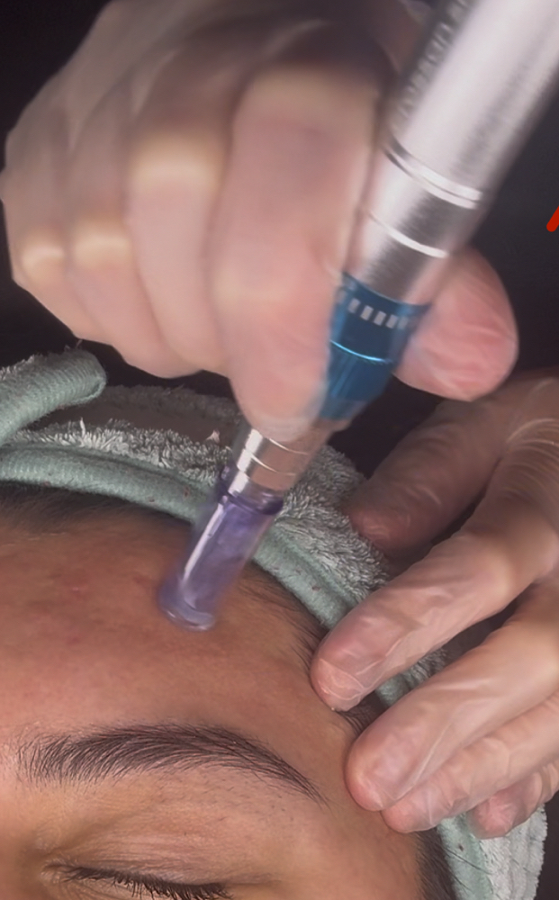 Nano Infusion Treatment