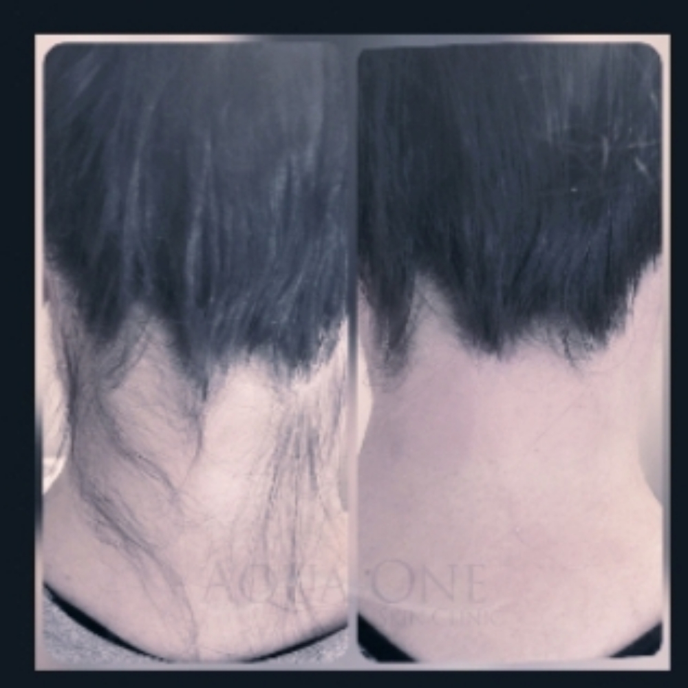 ADD-ON Hairline (Nape) at Aqua One Skin Clinic in Jasper, IN