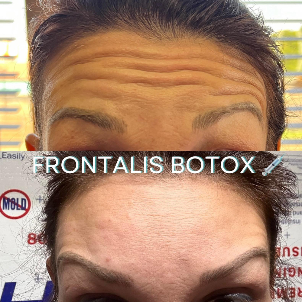 Tox- Forehead & 11’s💉 at BeautyHolic Aesthetics LLC in Lubbock, TX