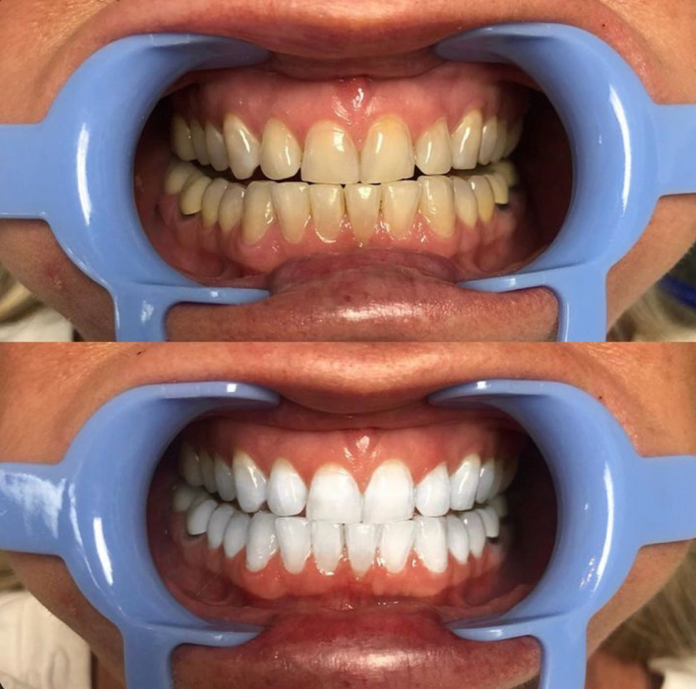 Advanced Teeth Whitening