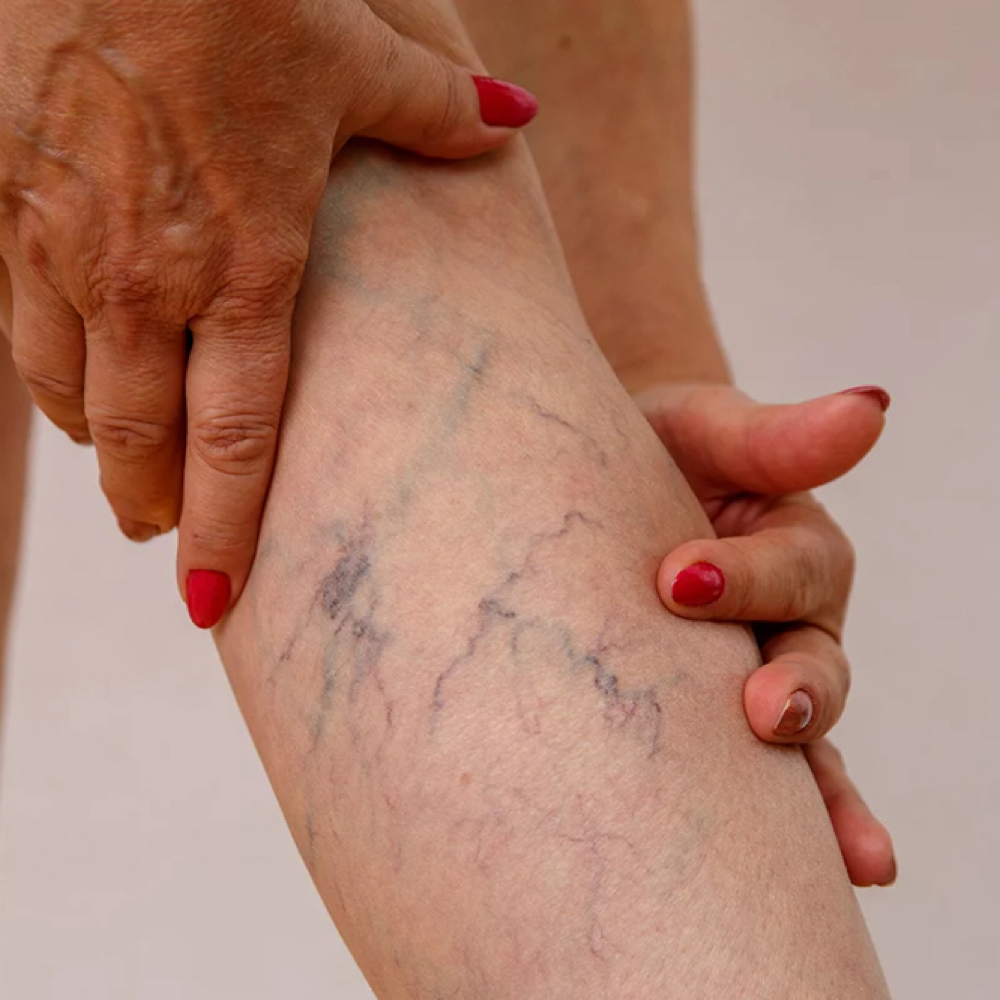 Spider Vein Treatment at The Refinery in Guntersville, AL