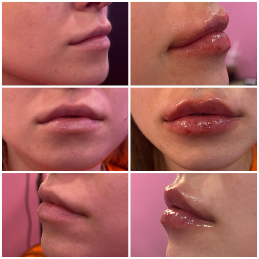 Lip Filler 1/2 Syringe $275