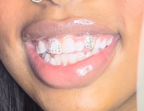 ‘ToothGlimmer’ Set