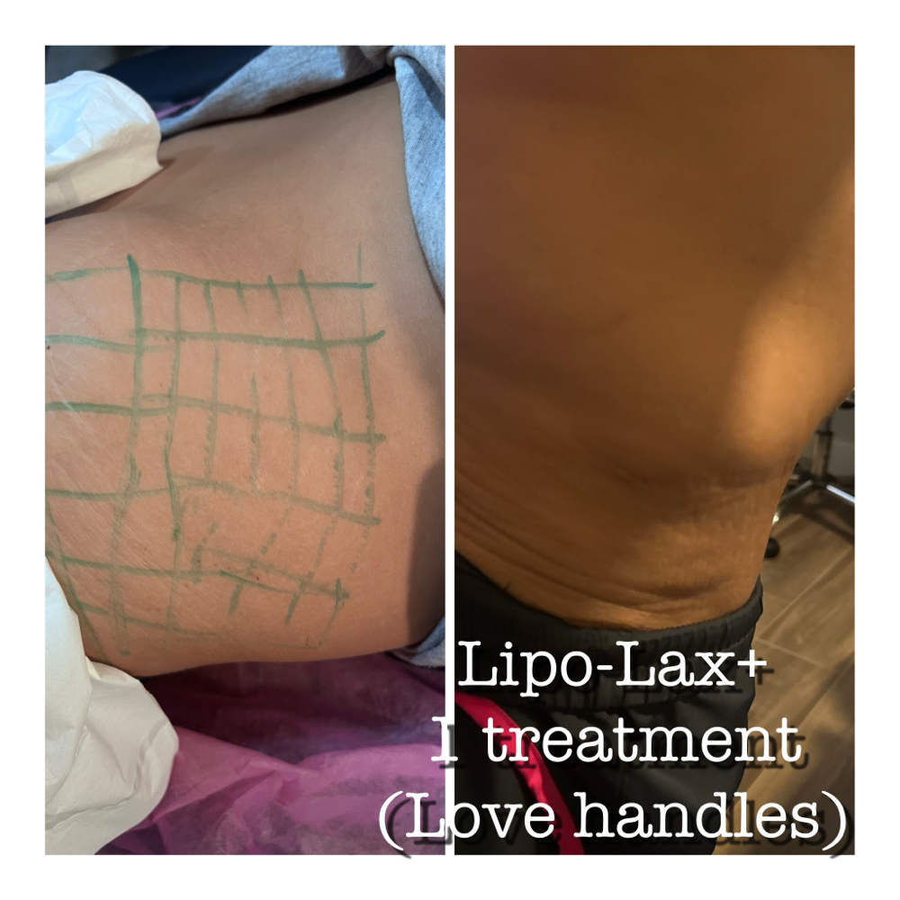 Lipo-Lax+ Love Handles