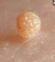 Skin Tag Removal (1)