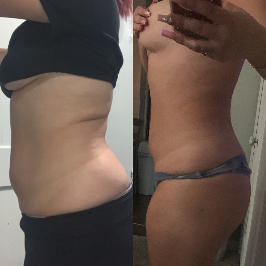 Lipo Shots (Belly)