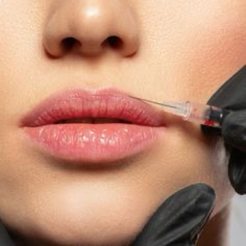 Lip Flip at Face Haus Aesthetics in Colorado Springs, CO