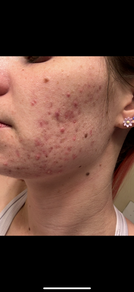 Acne Facial