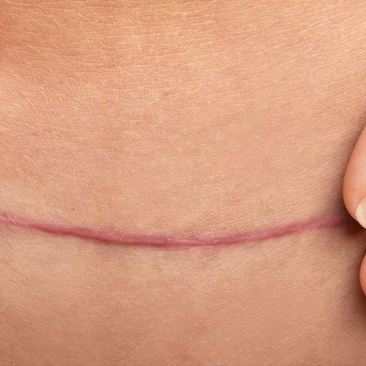 Surgical Scar Cover UP at Cosmetic Studio 54 in Los Angeles, CA