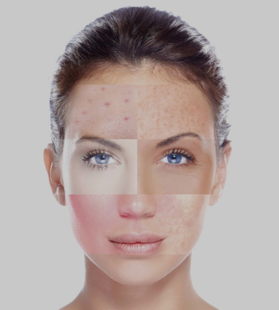 Herbal Green Peel at Soluna Studio /Beauty & Wellness in Forest Hills, NY