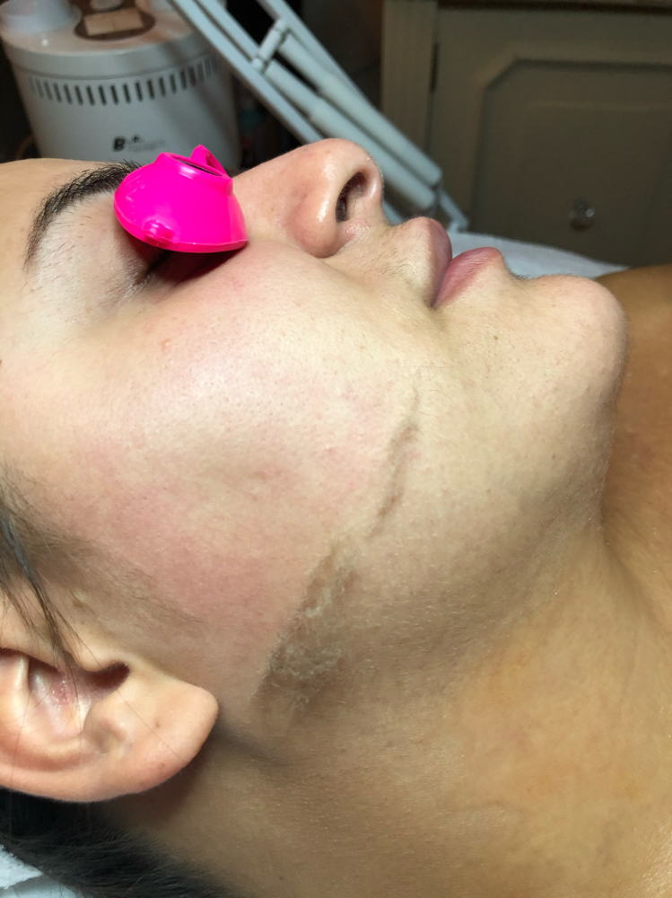 Dermaplane Facial