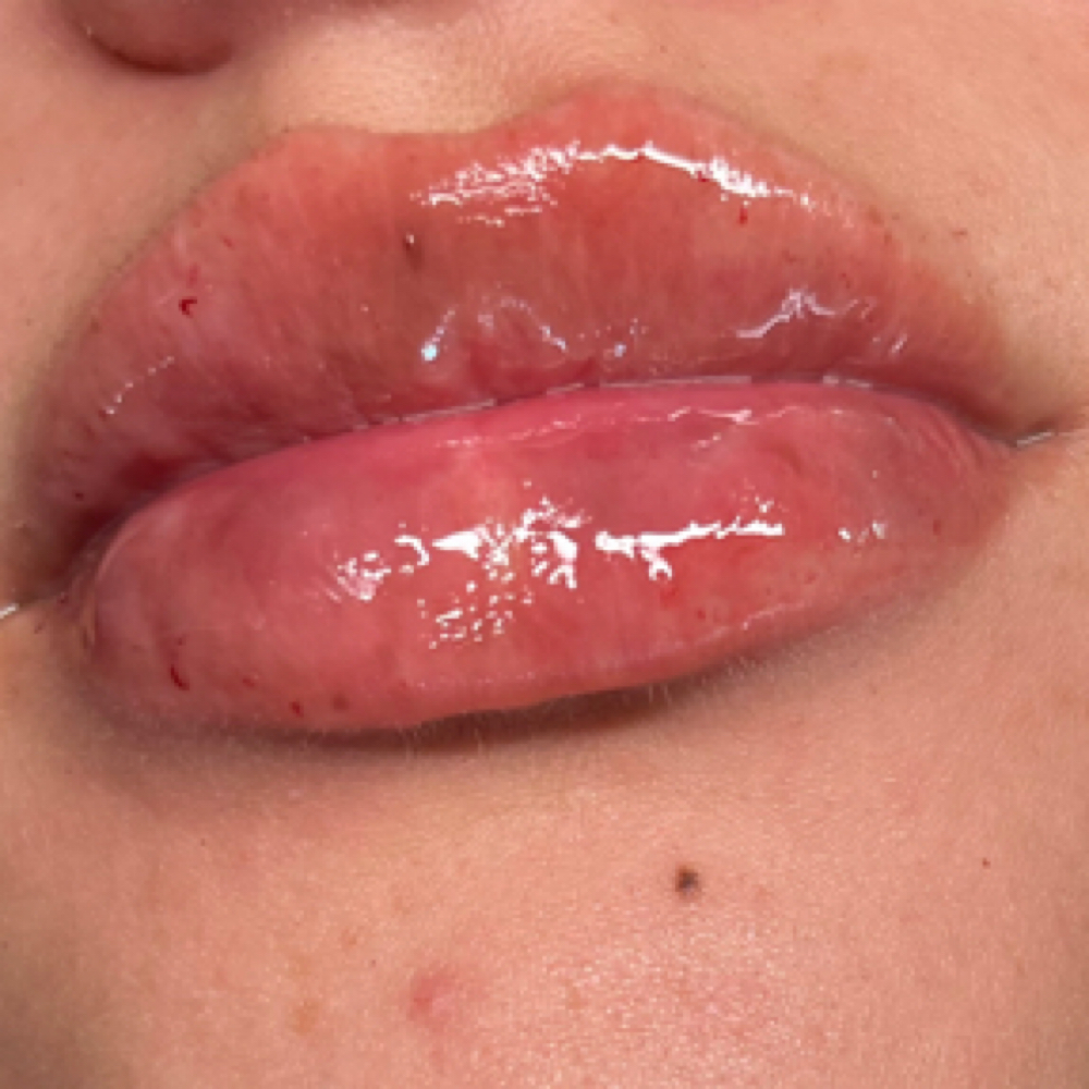 NEEDLESS lip Filler at Domain Lips N Lashes in Corpus Christi, TX