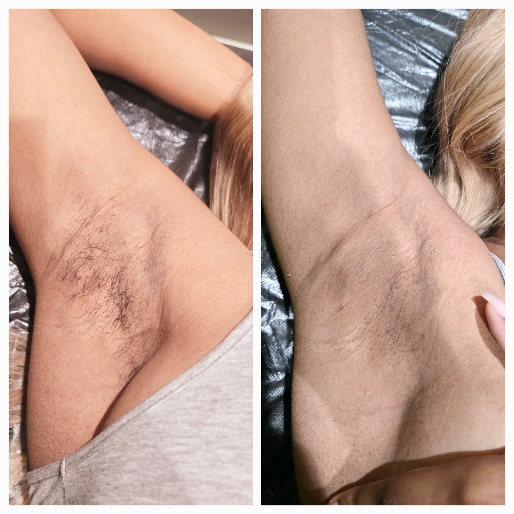 Waxing Hair Removal
