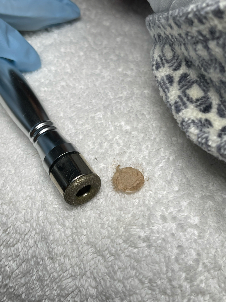 Micro Dermabrasion Add On