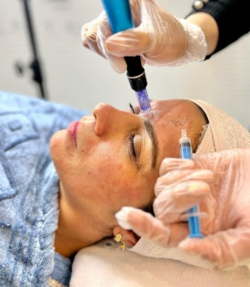 MICRONEEDLING