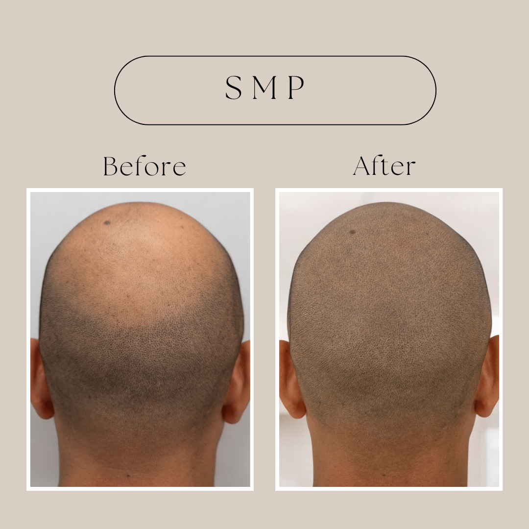 Scalp Micropigmentation (SMP)