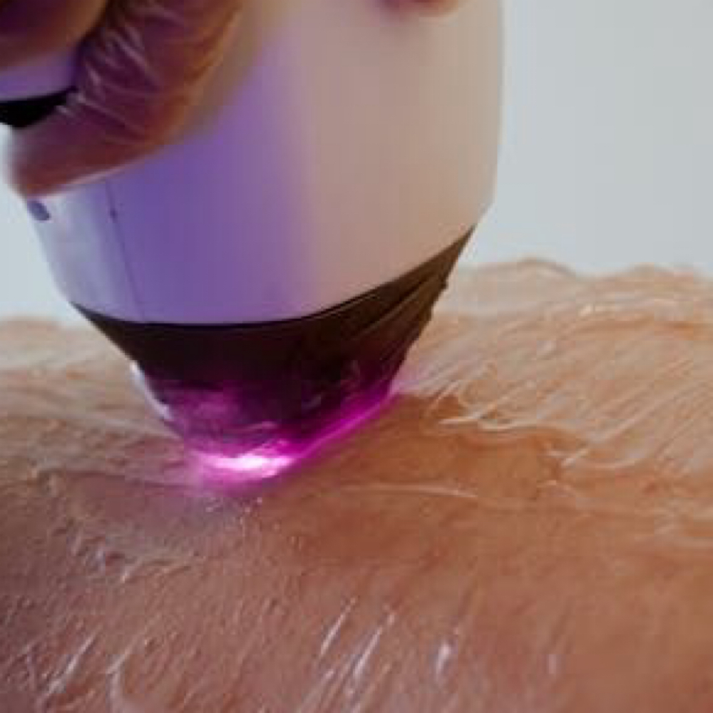 Small Area at MySkin Aesthetics in Laredo, TX