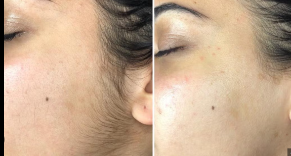 Dermaplaning
